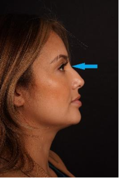 rhinoplasty patient 1