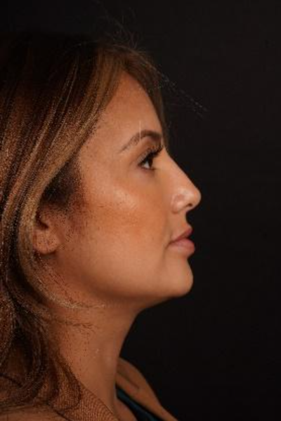 rhinoplasty patient 2