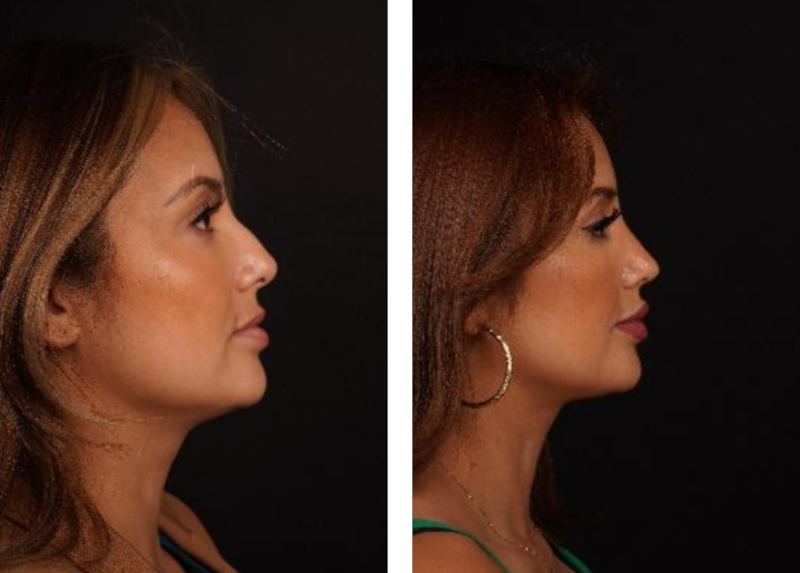 rhinoplasty before and after