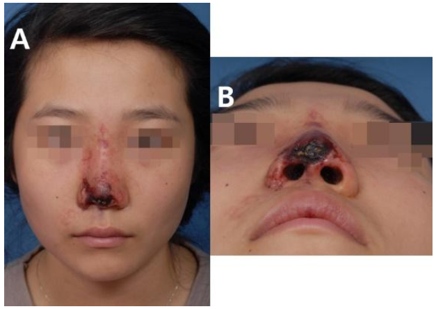 injectable filler complications