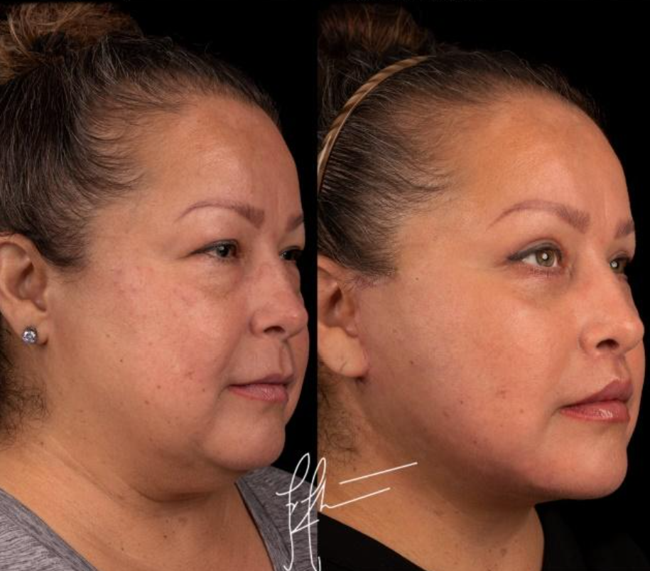 fat transfer example 1