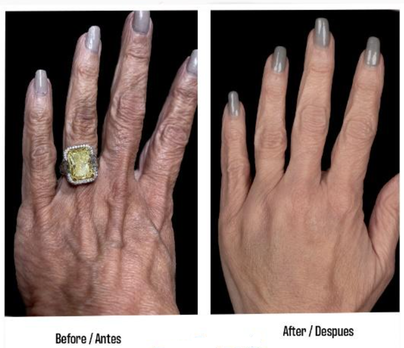 fat transfer to hands