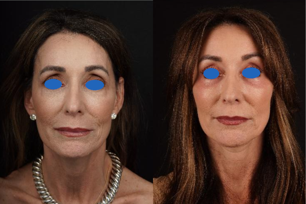 facial fat transfer 2