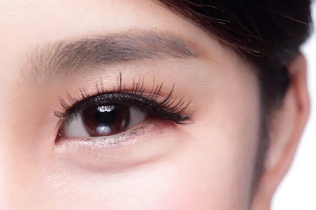 Asian-eyelid-surgery-1