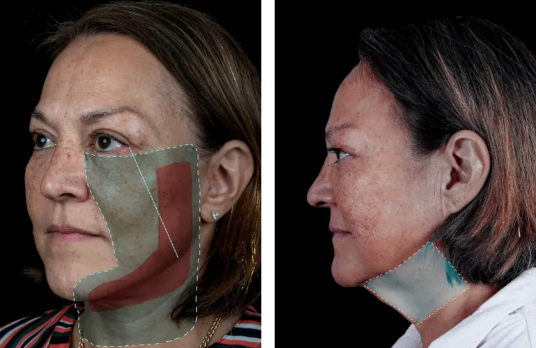 Difference in dissection area between RT Mini Face lift and Neck Lift