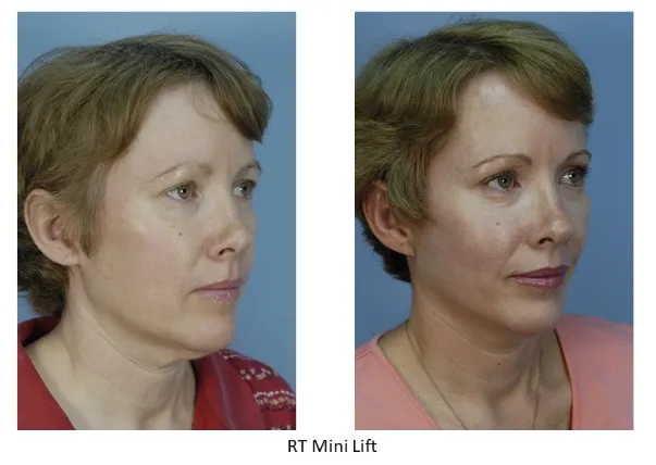 The above photograph perfectly describes a RT Mini Lift candidate and shows a RT Mini Facelift patient before and after. The patient has mild aging in the midface, jawline and neck. She does not have a very heavy neck, otherwise she might need a lower facelift or neck lift modification to the RT Mini Facelift. And, her results are stunning.