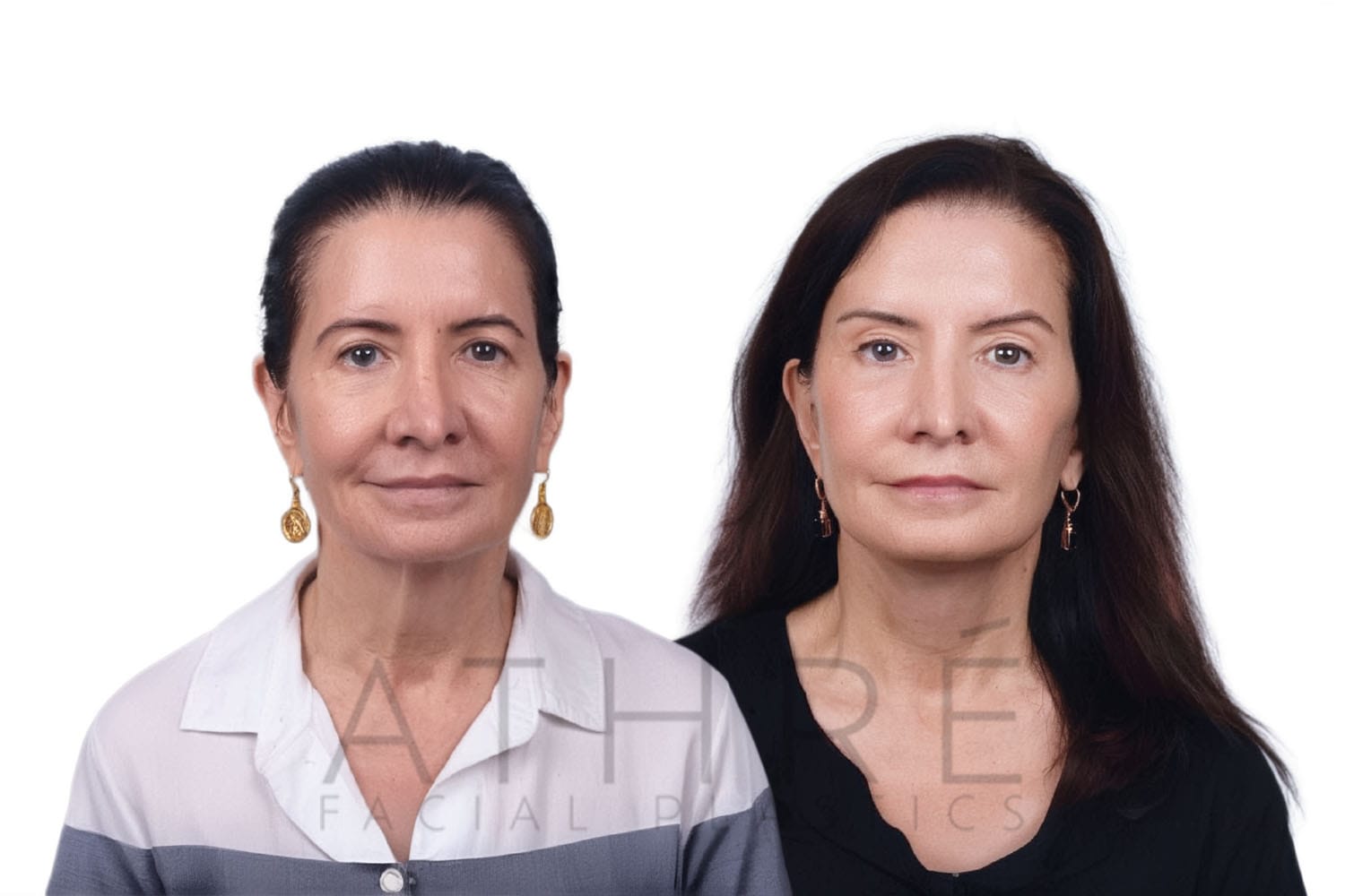 Side-by-side profile photos of a woman before and after a facelift