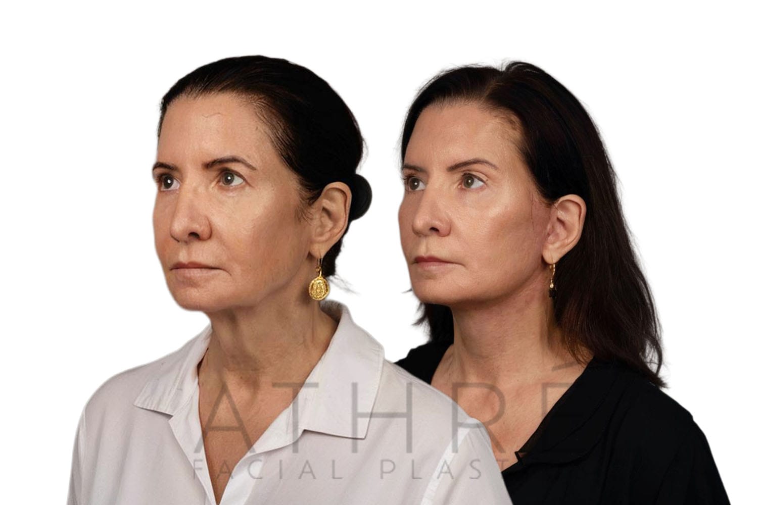 Side-by-side profile photos of a woman before and after a facelift
