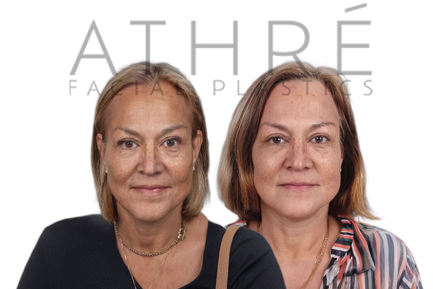 Side-by-side profile photos of a woman before and after a facelift
