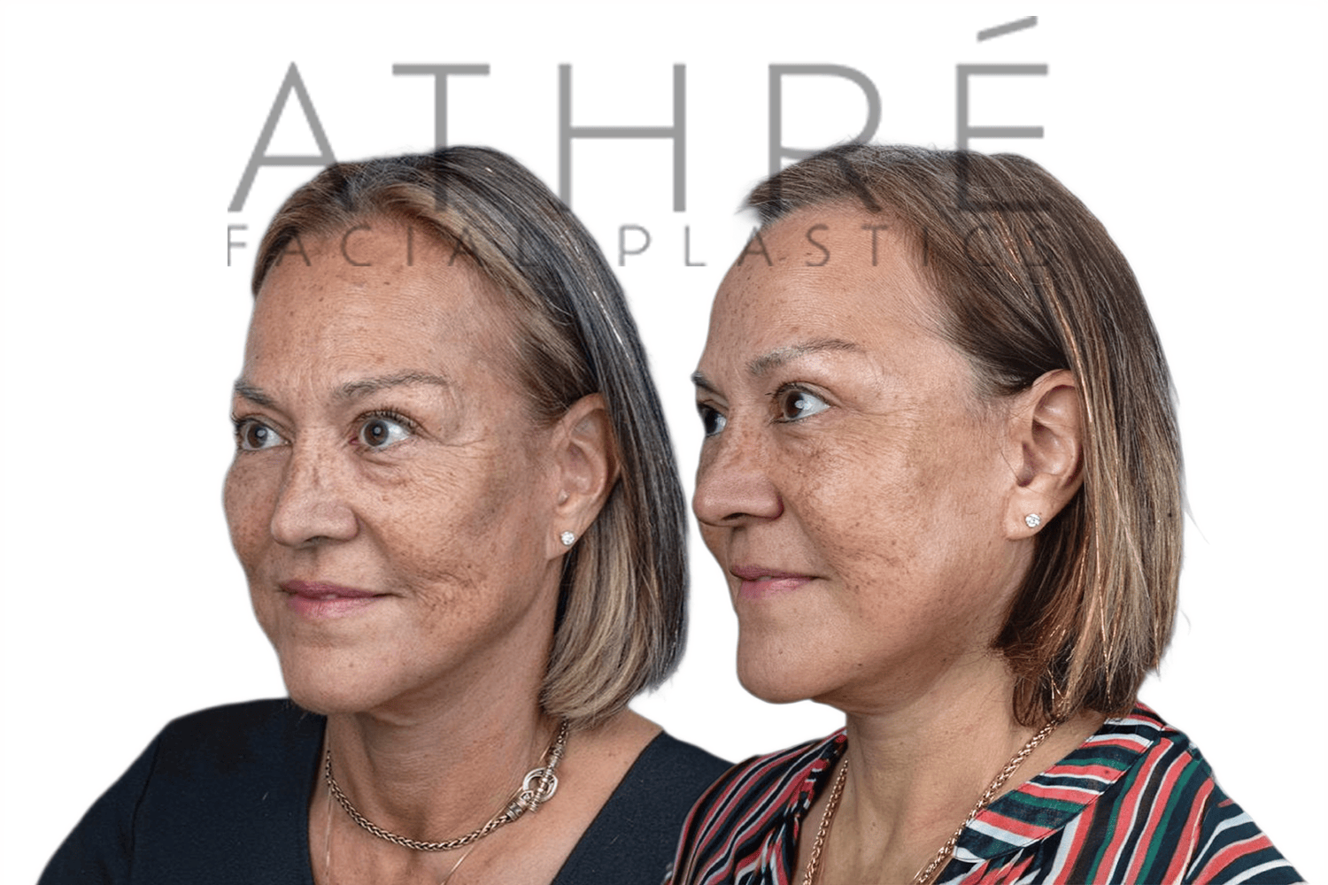 Side-by-side profile photos of a woman before and after a facelift