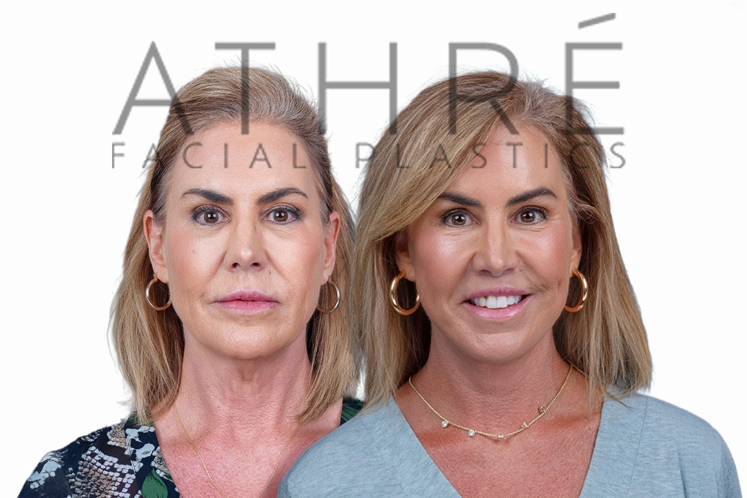 Side-by-side profile photos of a woman before and after a facelift