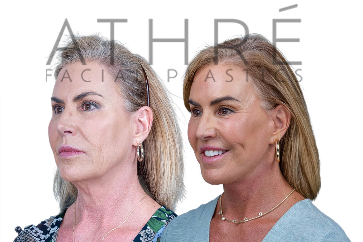 Side-by-side profile photos of a woman before and after a facelift