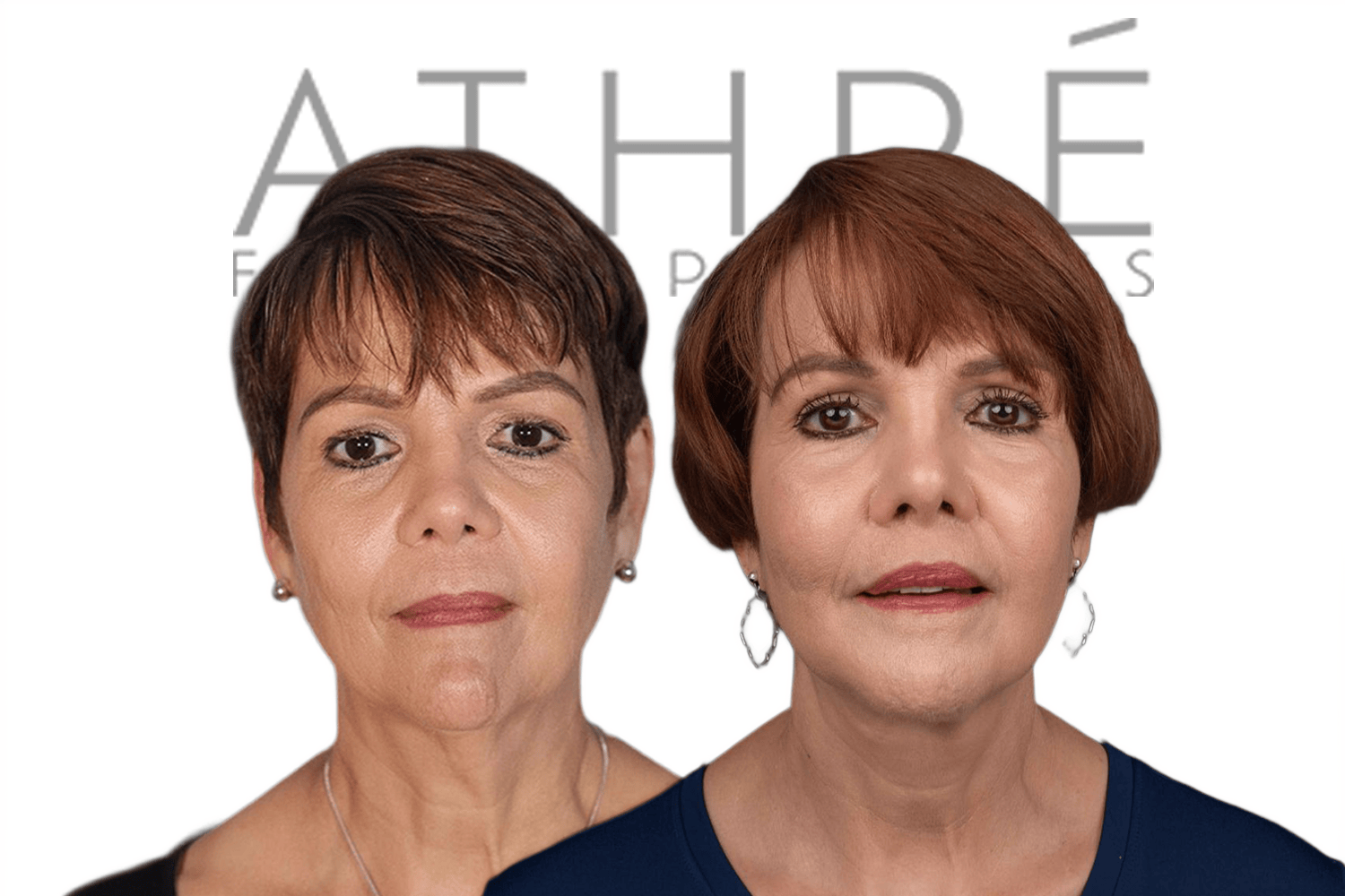 Side-by-side profile photos of a woman before and after a facelift