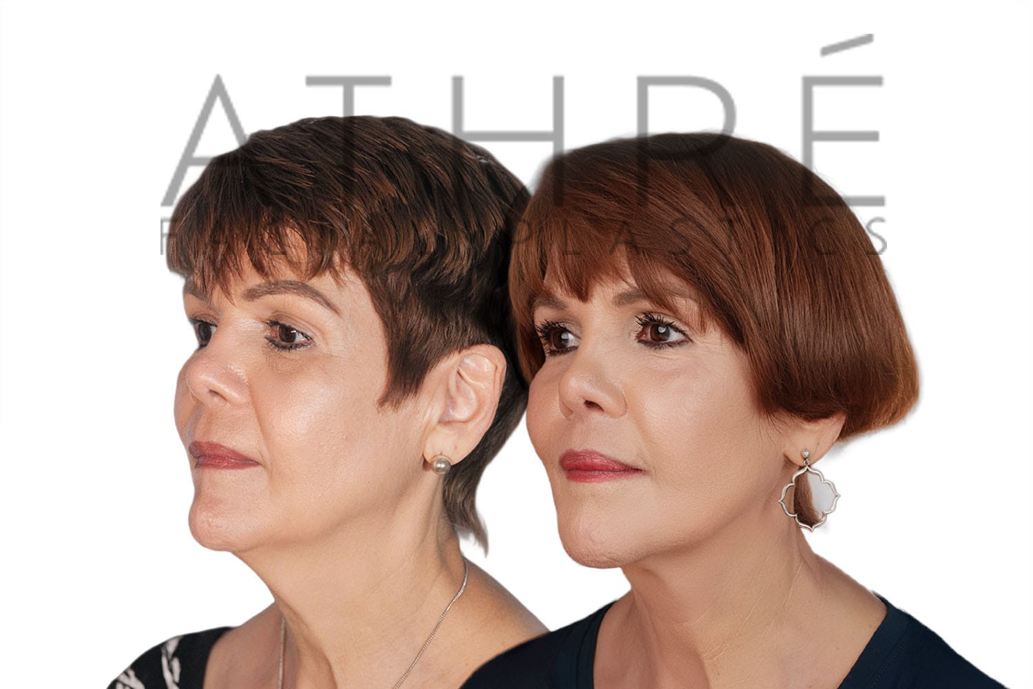 Side-by-side profile photos of a woman before and after a facelift