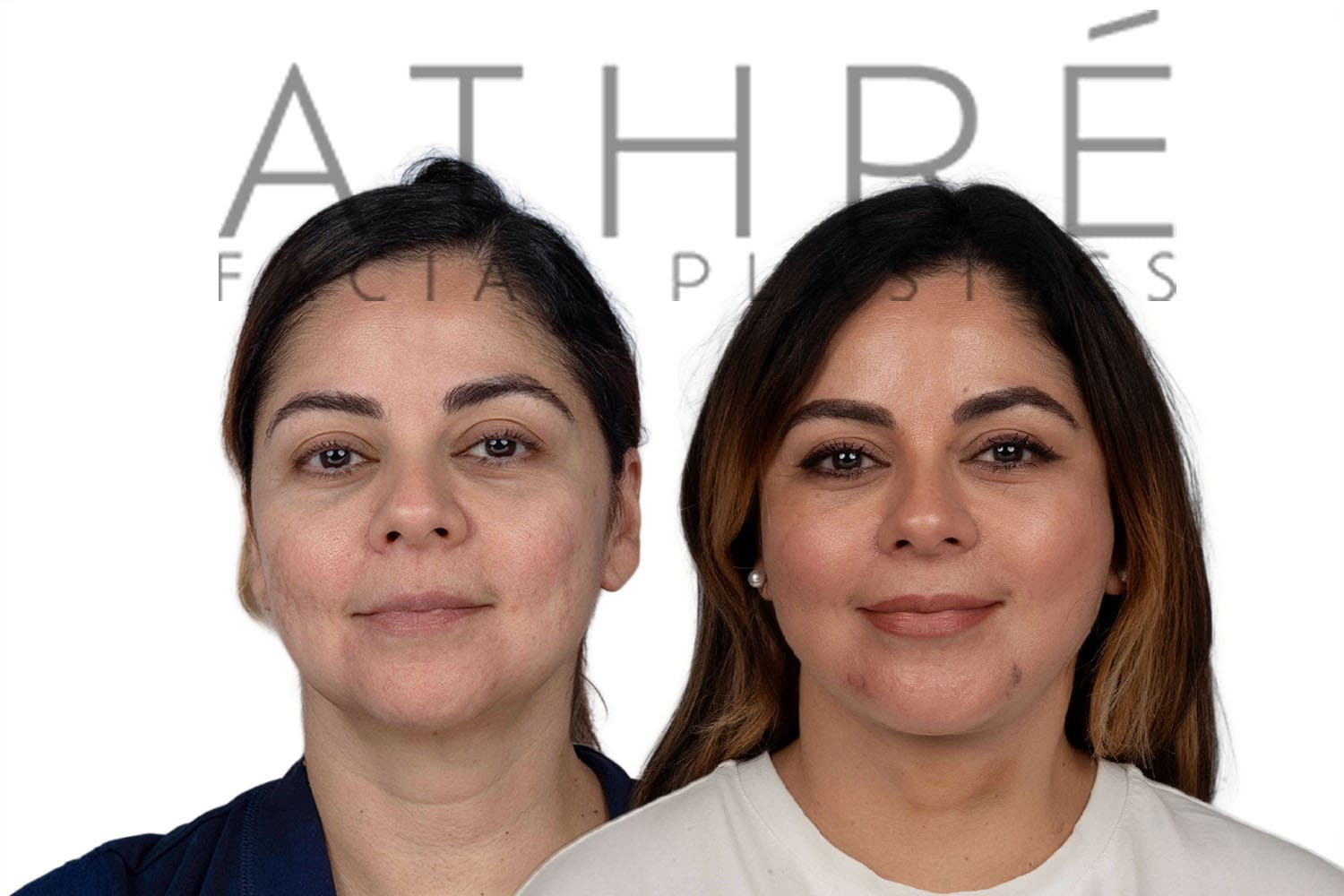 Side-by-side profile photos of a woman before and after a facelift