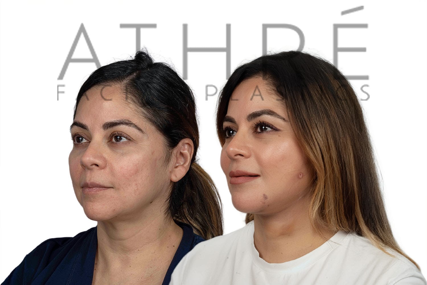Side-by-side profile photos of a woman before and after a facelift