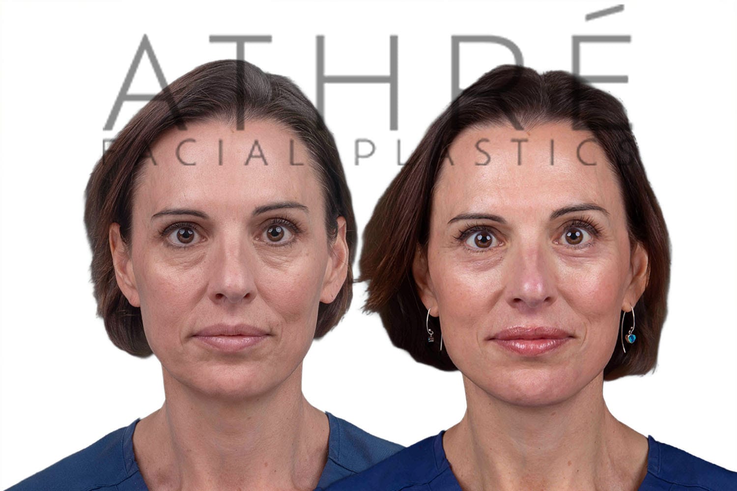 Side-by-side profile photos of a woman before and after a facelift