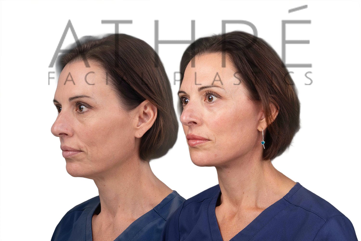 Side-by-side profile photos of a woman before and after a facelift