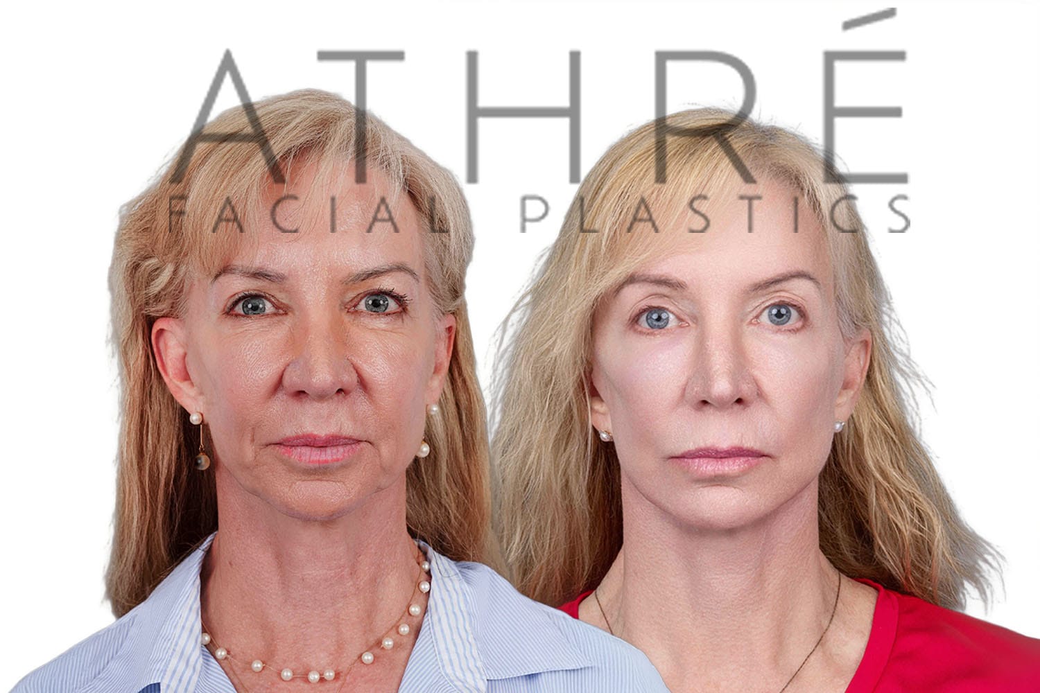 Side-by-side profile photos of a woman before and after a facelift
