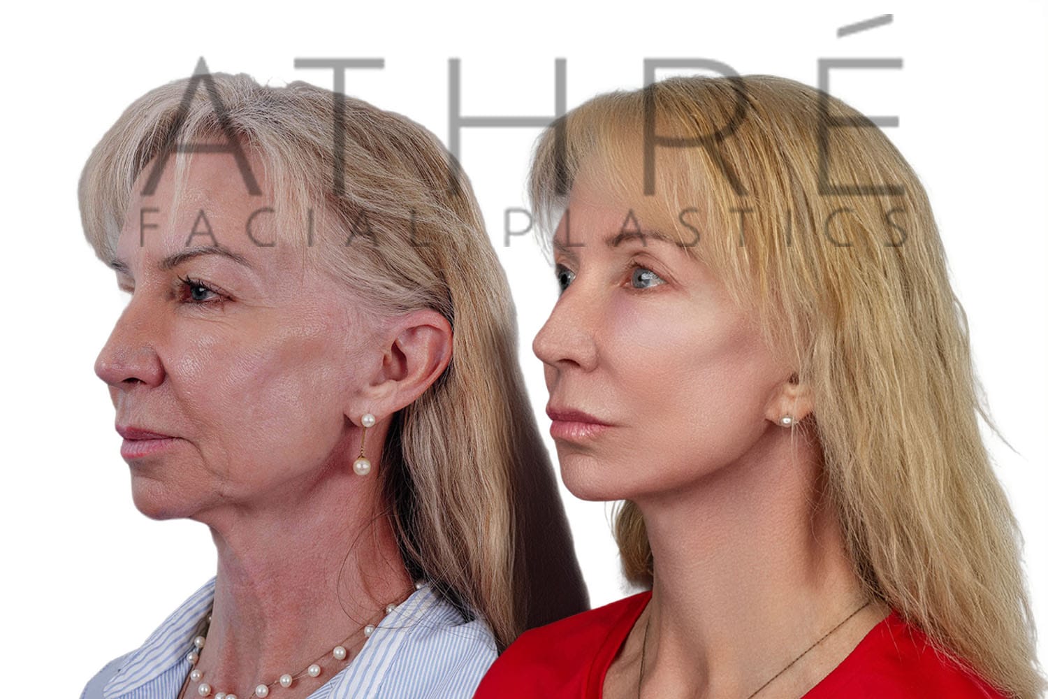 Side-by-side profile photos of a woman before and after a facelift