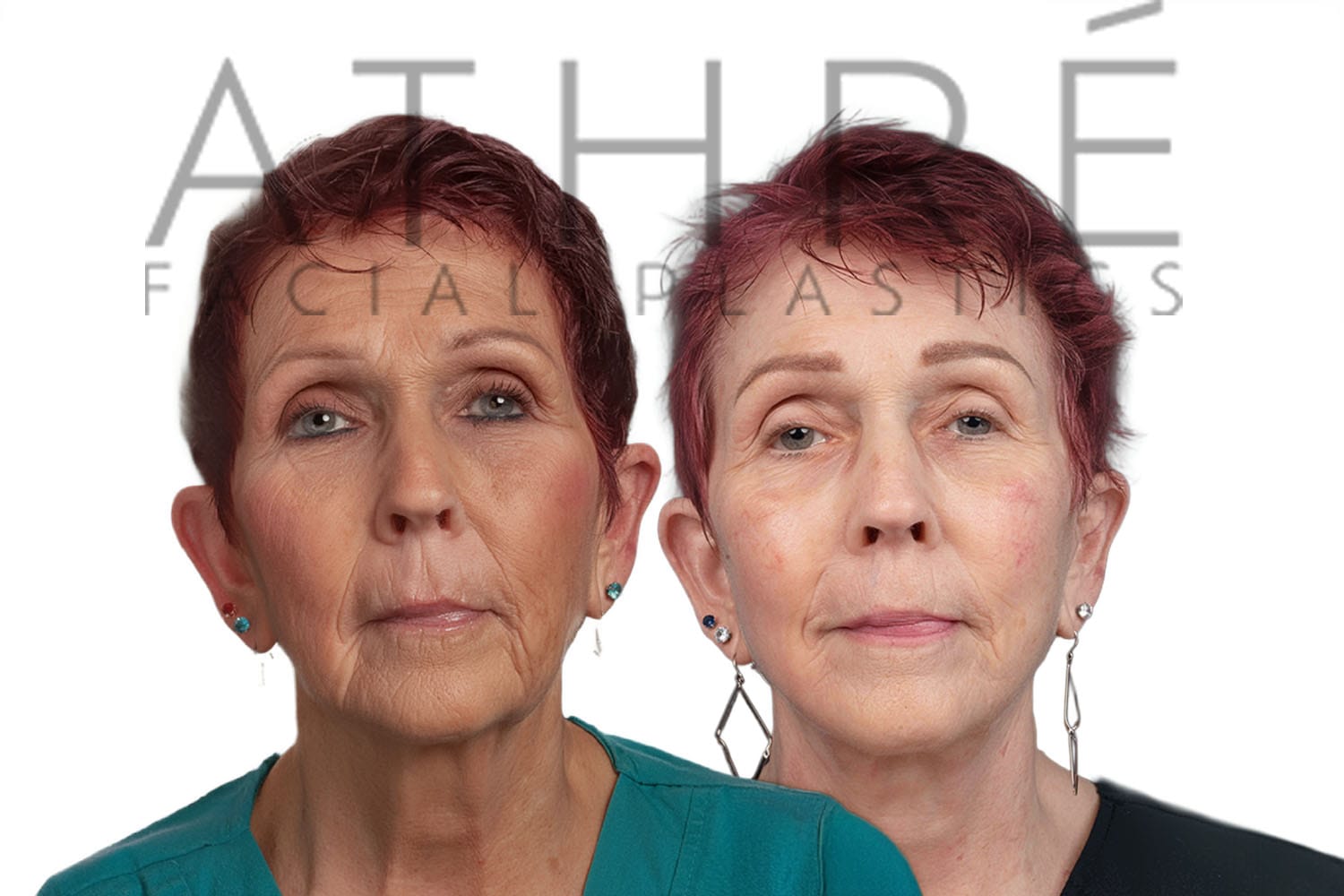 Side-by-side comparison of an older woman before and after a facial procedure, with visible changes to skin texture and firmness.
