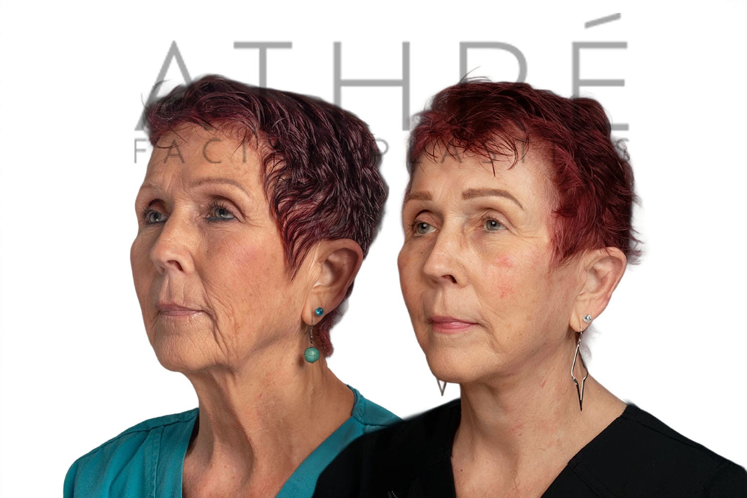 Side-by-side profile photos of a woman before and after a facelift