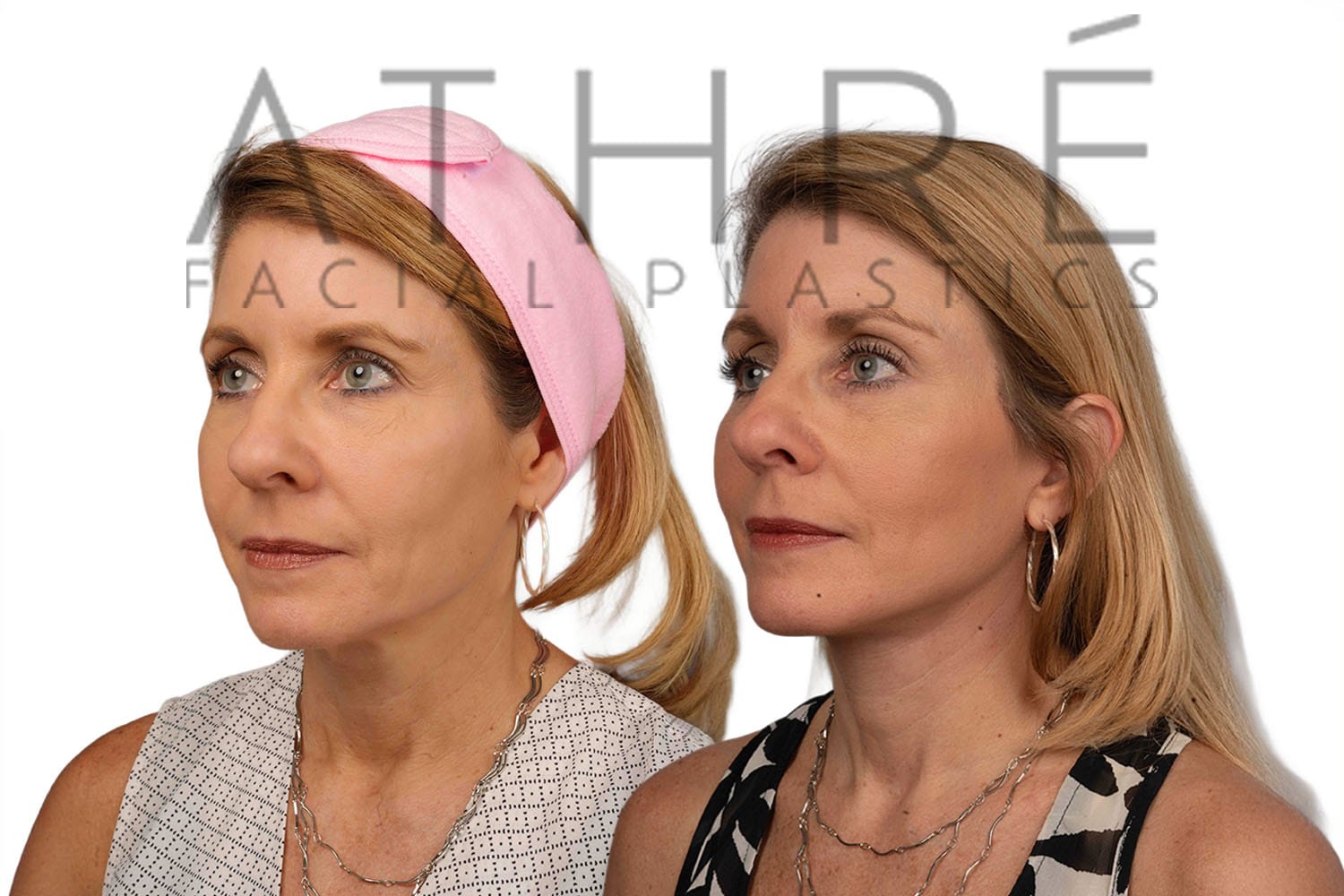 Side-by-side profile photos of a woman before and after a facelift