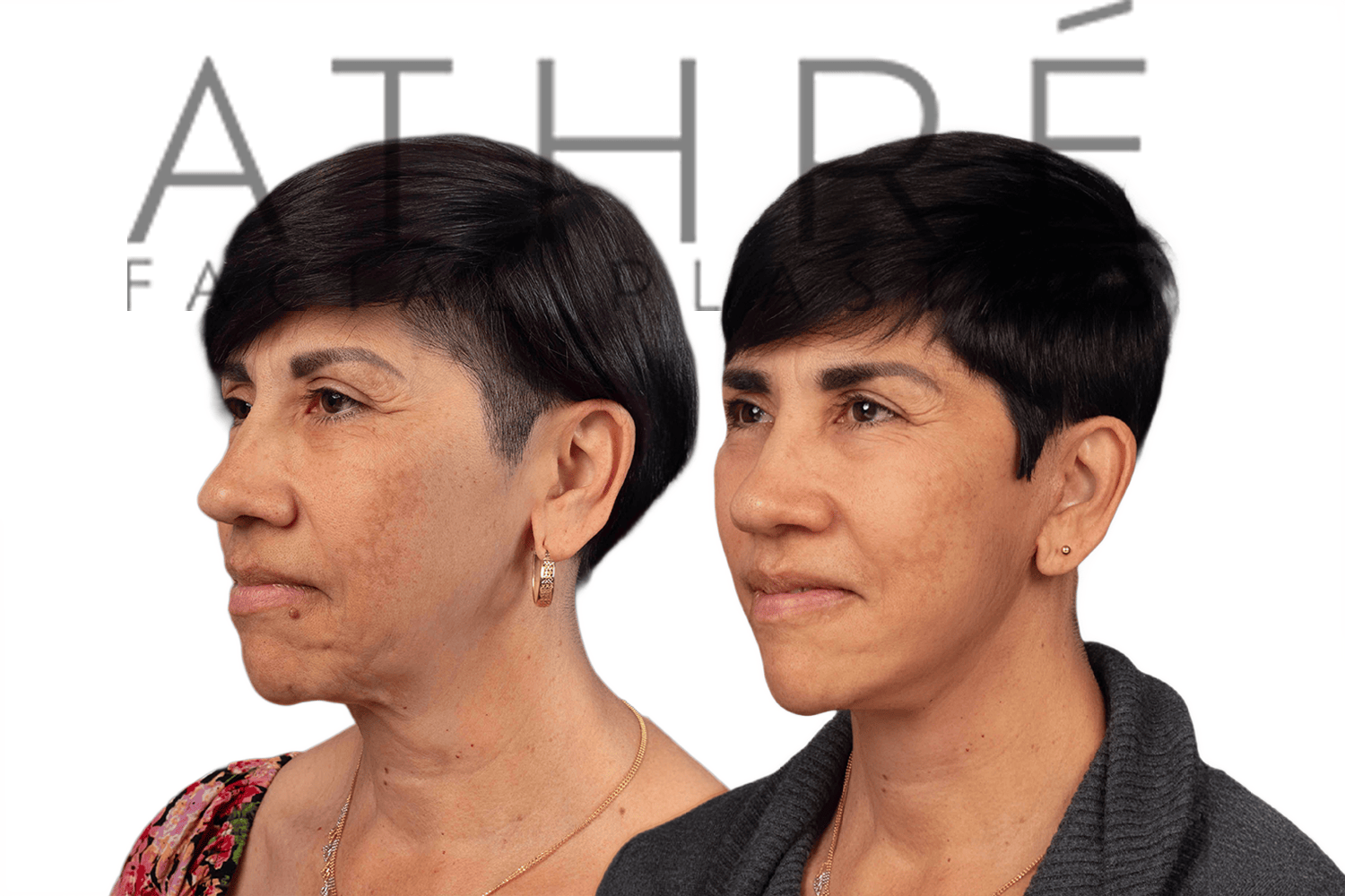Side-by-side profile photos of a woman before and after a facelift