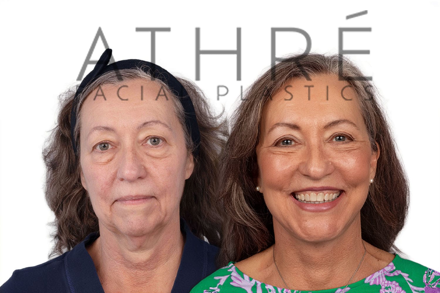 Side-by-side profile photos of a woman before and after a facelift