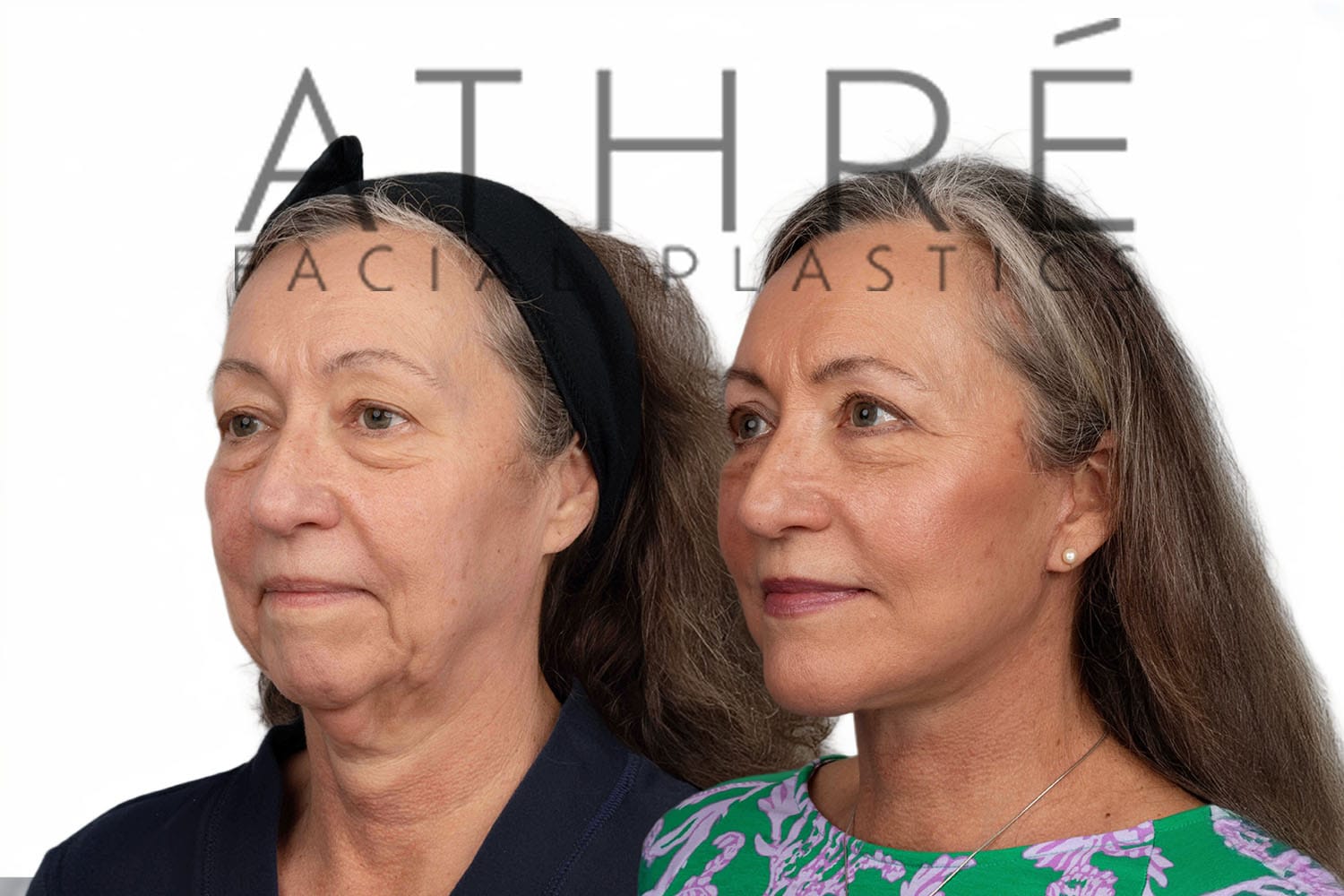 Side-by-side profile photos of a woman before and after a facelift
