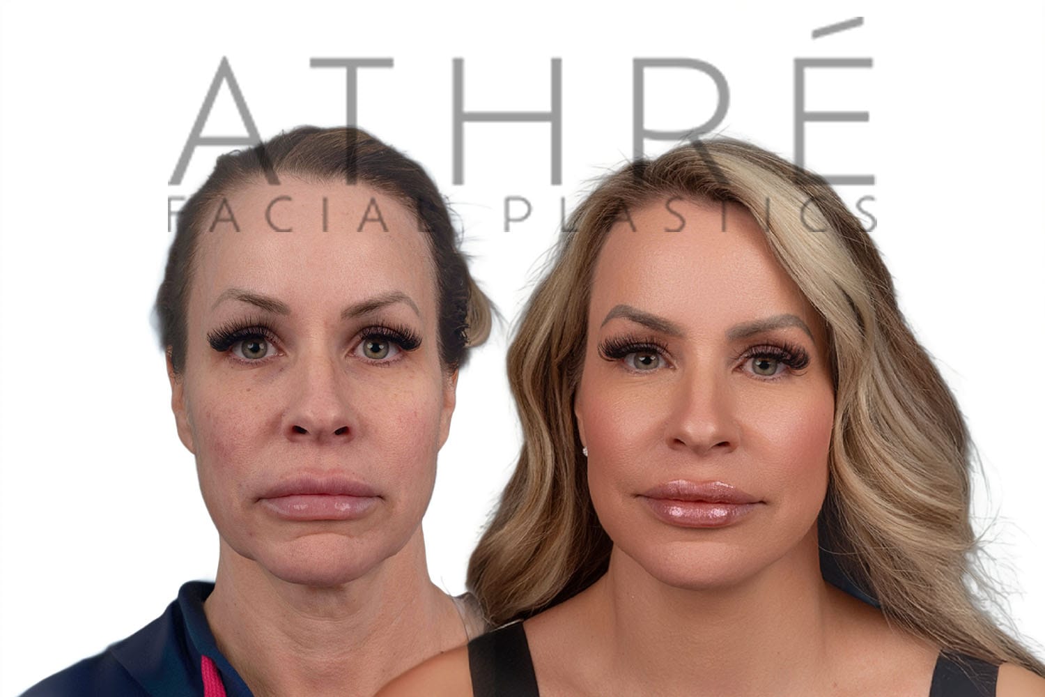 Side-by-side profile photos of a woman before and after a facelift