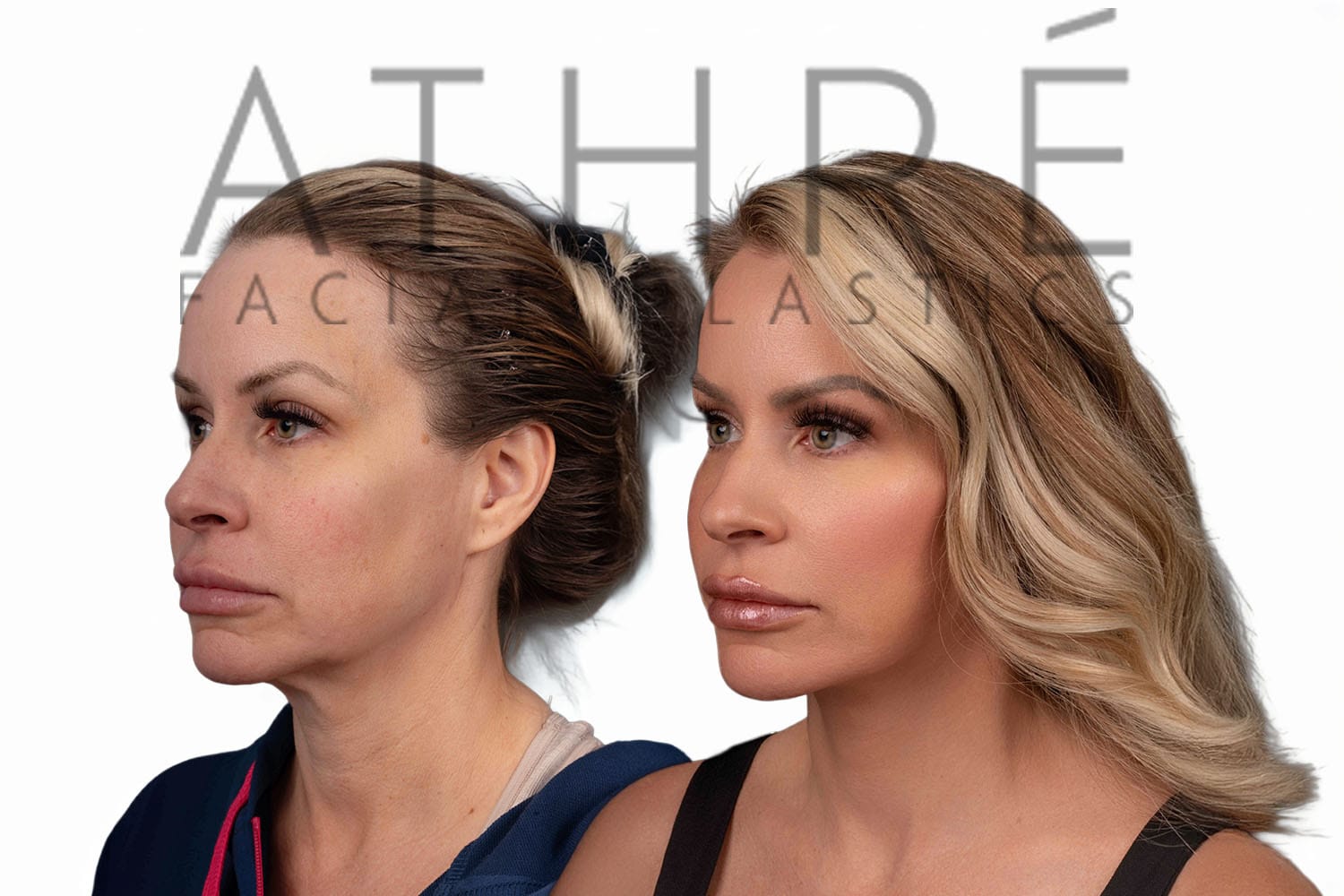 Side-by-side profile photos of a woman before and after a facelift
