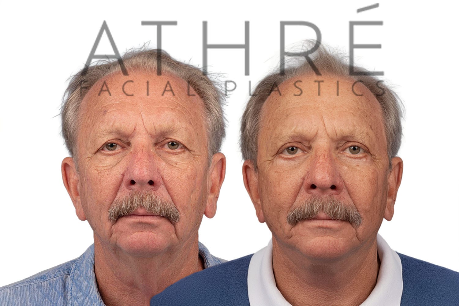 Side-by-side profile photos of a woman before and after a facelift