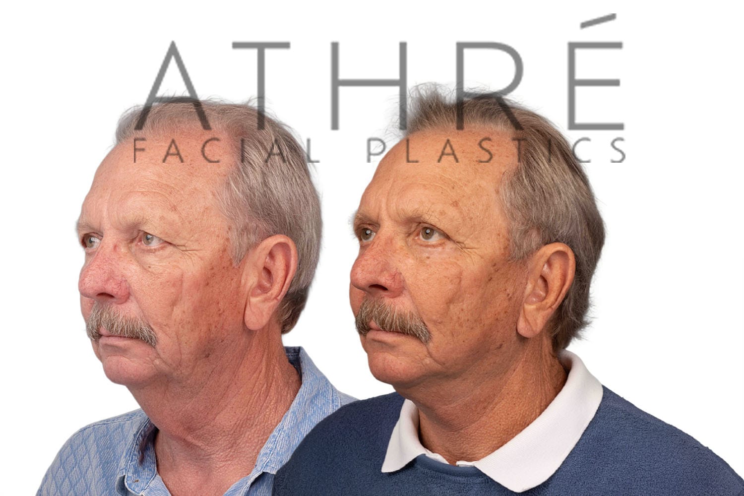 Side-by-side profile photos of a woman before and after a facelift