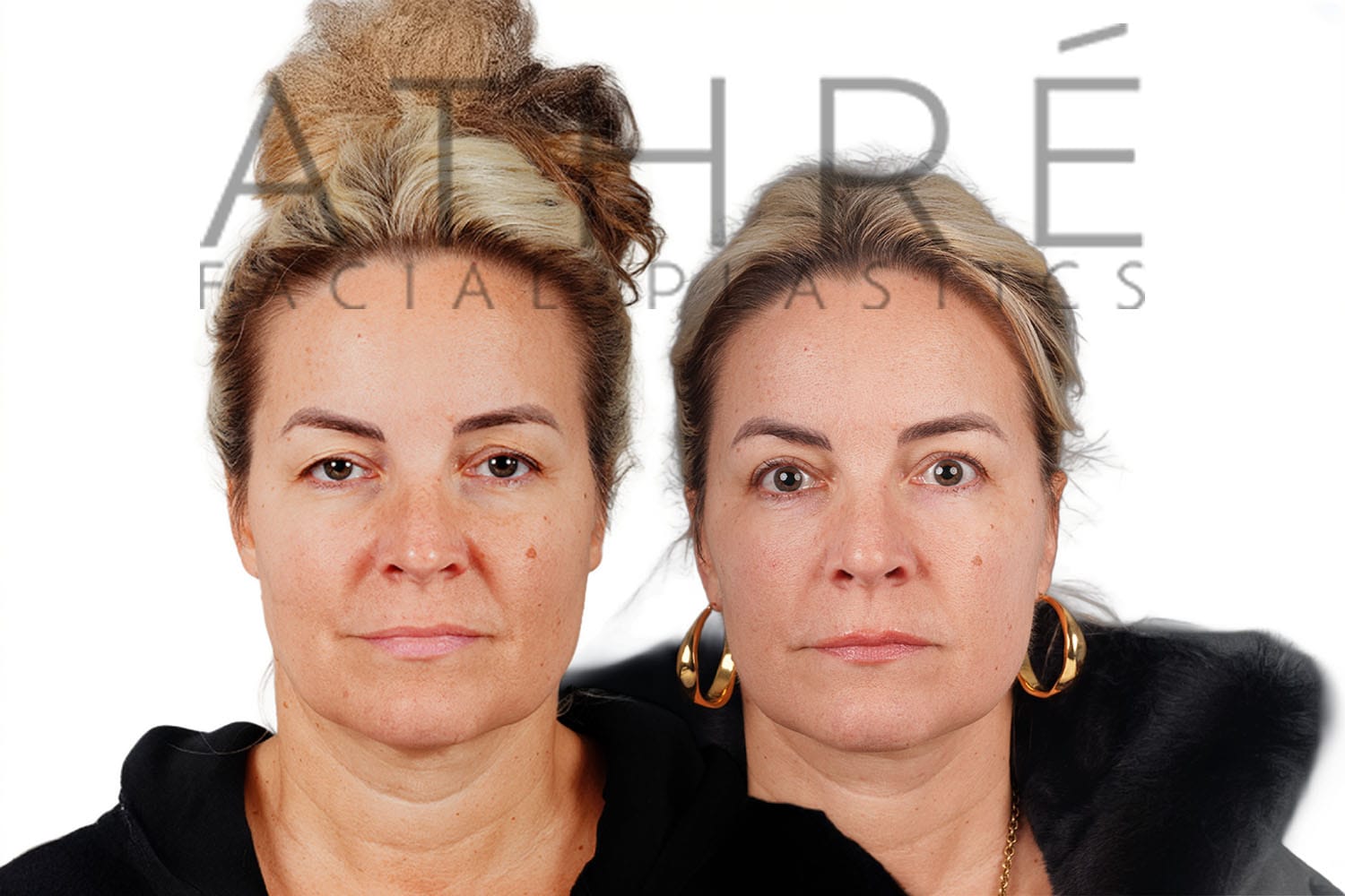 Side-by-side profile photos of a woman before and after a facelift
