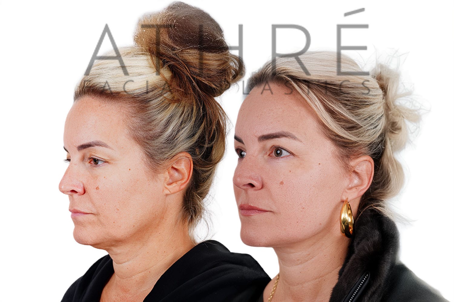 Side-by-side profile photos of a woman before and after a facelift