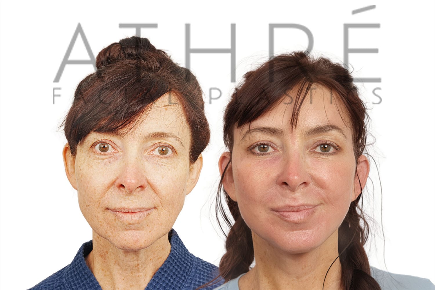 Side-by-side profile photos of a woman before and after a facelift
