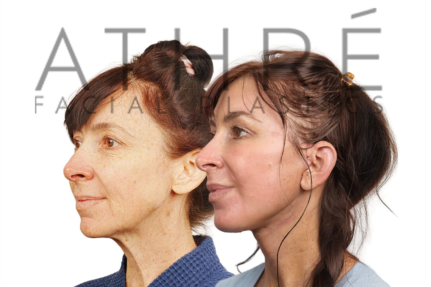 Side-by-side profile photos of a woman before and after a facelift