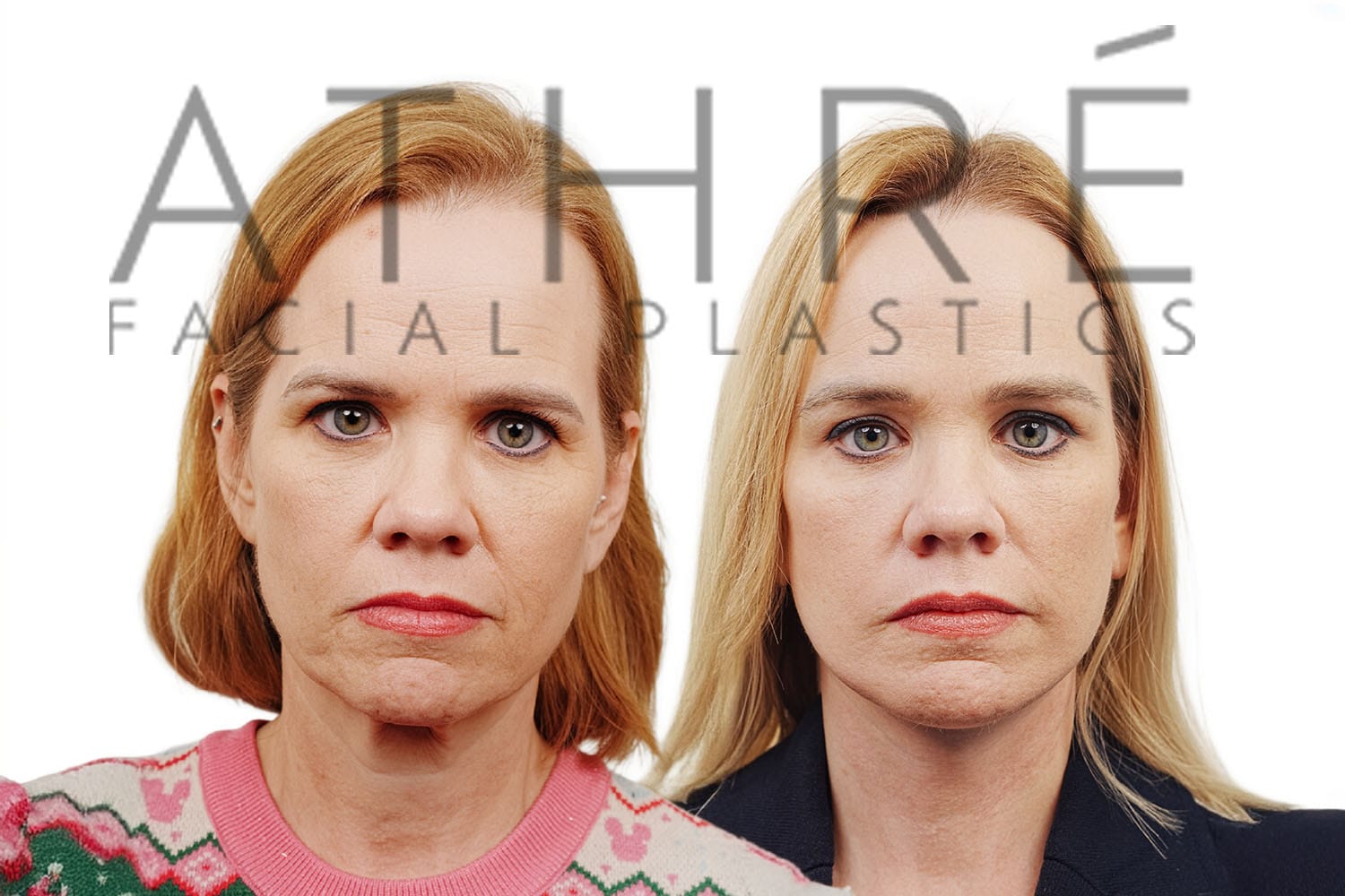 Side-by-side profile photos of a woman before and after a facelift