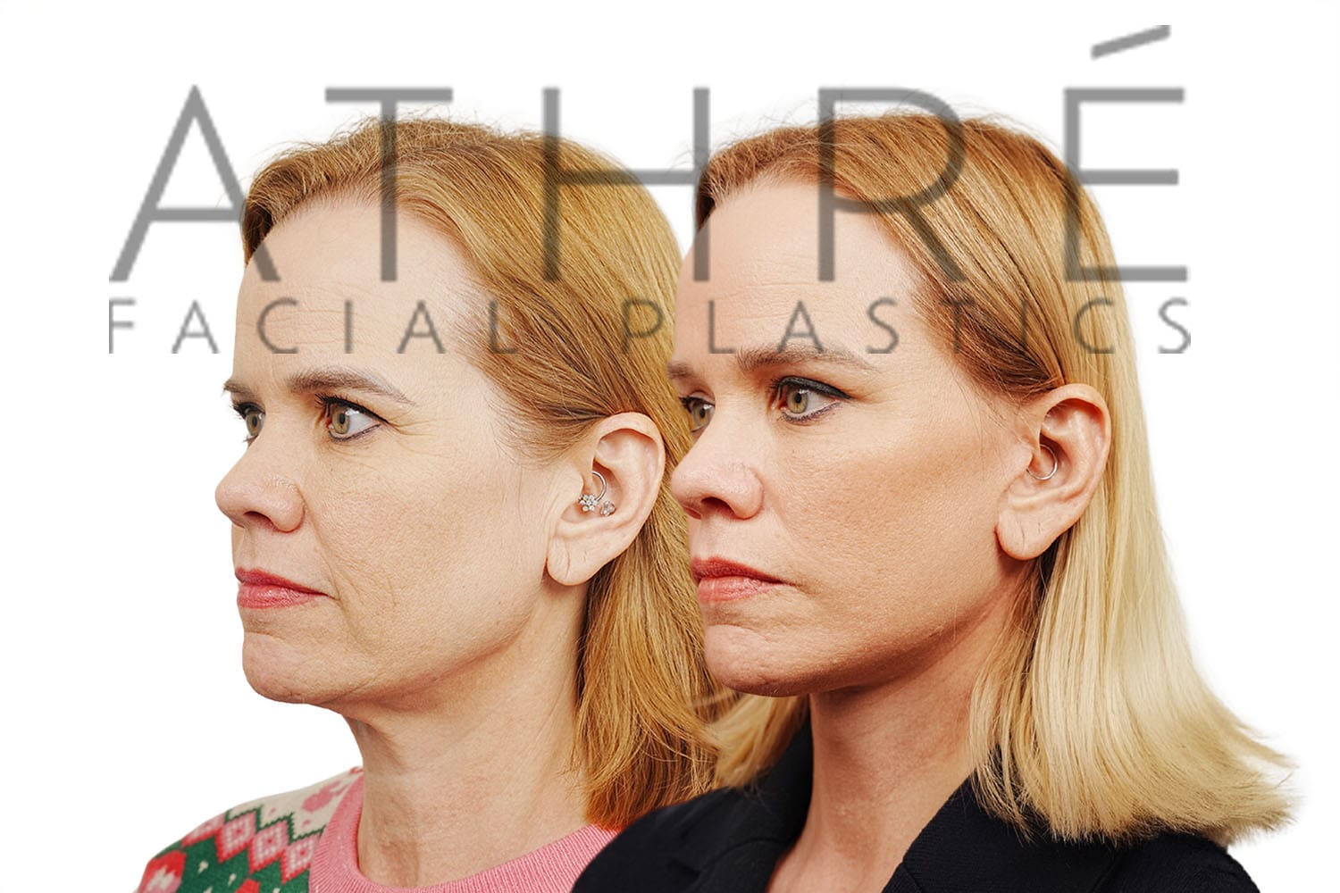 Side-by-side profile photos of a woman before and after a facelift