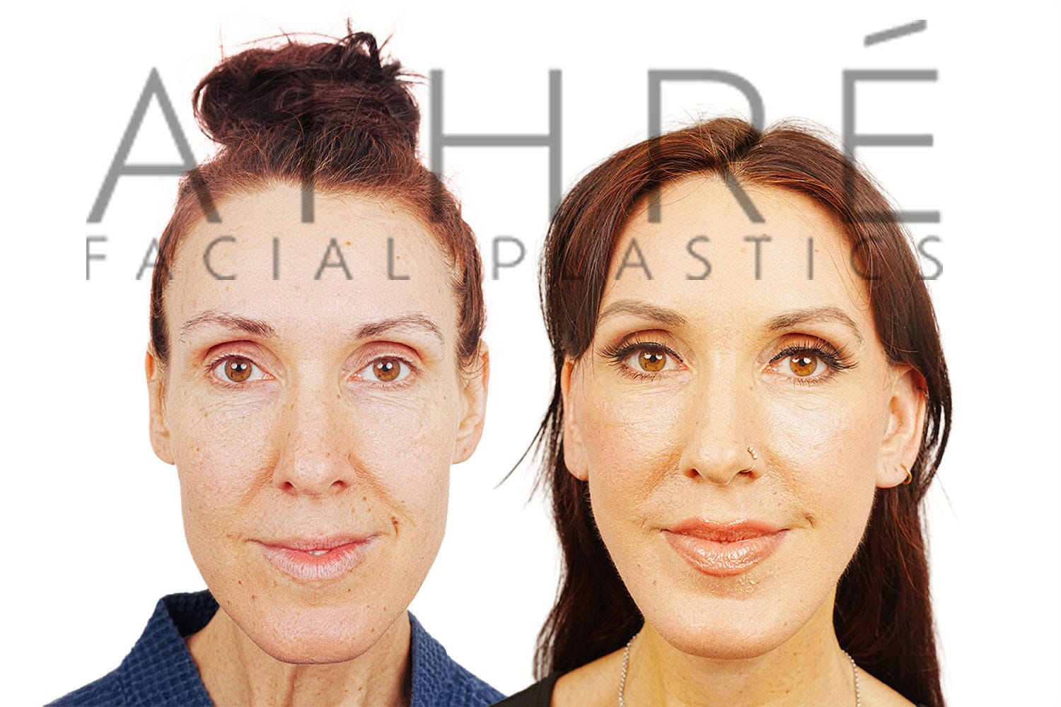 Side-by-side profile photos of a woman before and after a facelift