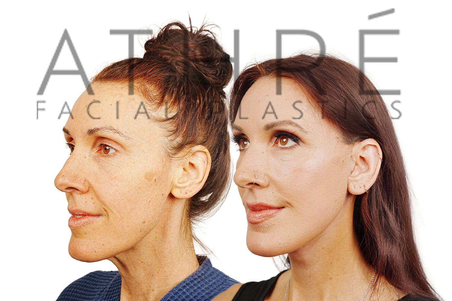 Side-by-side profile photos of a woman before and after a facelift