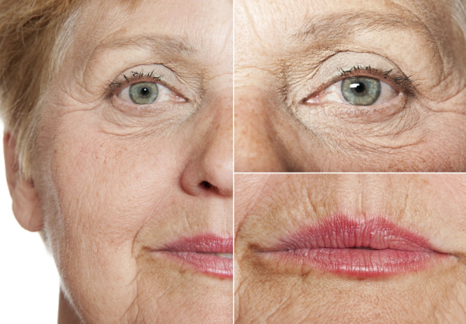 This photo shows how the fine lines and skin textural changes develop over the face.