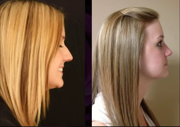 example of a barbie or cheerleader nose