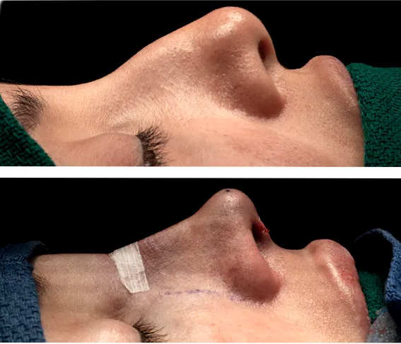 Example of a bulbous or fleshy nose shape.