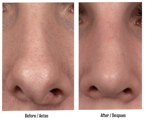 External appearance of a deviated septum.