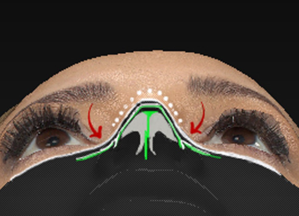 doral-preservation-rhinoplasty-1-1