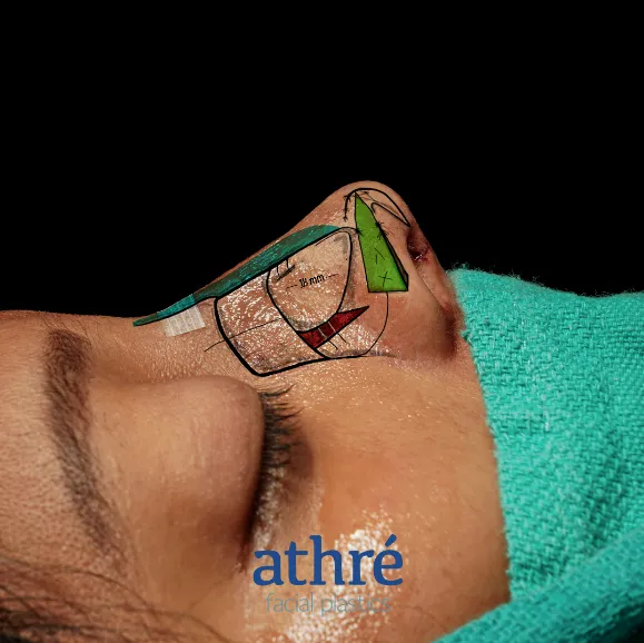 doral-preservation-rhinoplasty-3