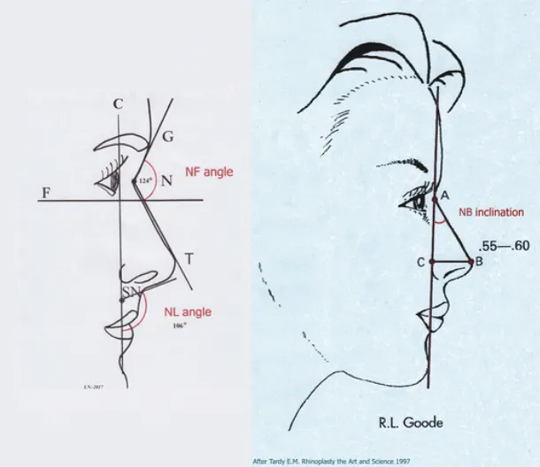 Left: modified from I.Niechajev, Noses of the Middle East: Variety of Phenotypes and Surgical Approaches. J Craniofac Surg 27(7):1701. Right: displayed with the permission of Elsevier publishers. From E.M. Tardy Rhinoplasty the Art and the Science, Saunders Co, 1977, Vol. II, p. 526)