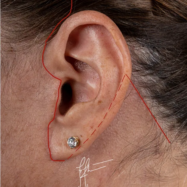 Example of facelift incision